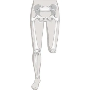 Protézy pro amputace a vrozené vady v kolenním kloubu - exartikulace