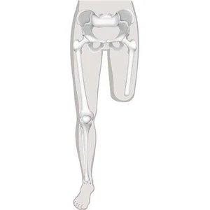 Protézy pro amputace a vrozené vady v oblasti stehna