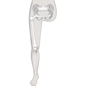 Protézy pro amputace a vrozené vady v kyčelním kloubu